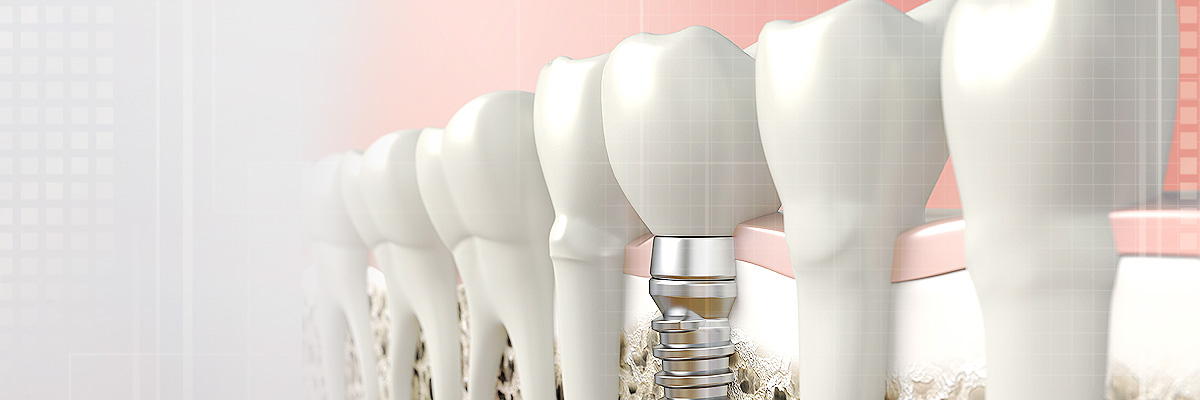 Dawsonville Implant Dentist