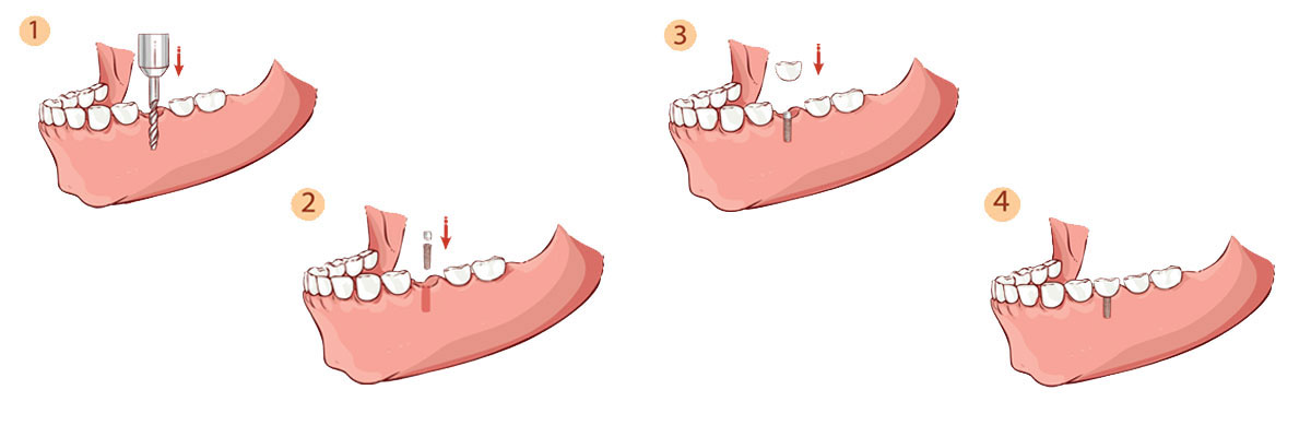 Dawsonville Dental Implant Restoration