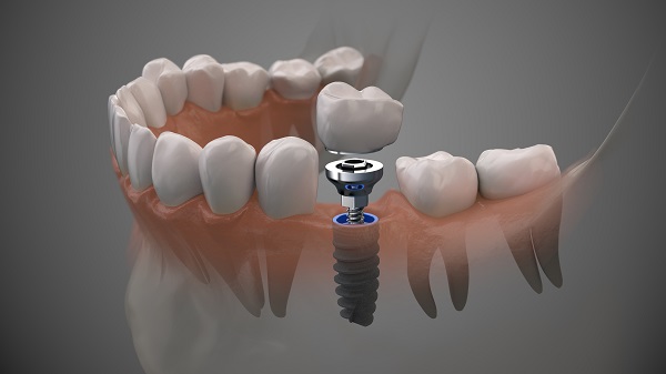 Dental Implants Dawsonville, GA