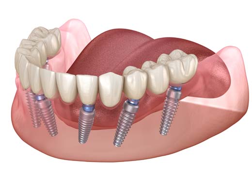 Implant Supported Dentures Dawsonville, GA
