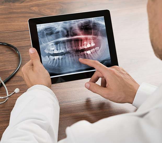 Dawsonville Types of Dental Root Fractures
